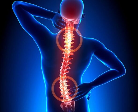 dolor en la columna vertebral con osteocondrosis