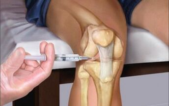 inyección intraarticular en la articulación para la artrosis
