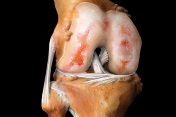 Daño del cartílago en la artrosis de la rodilla. 