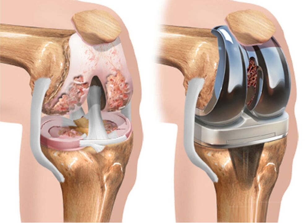 antes y después de la artrosis de la articulación de la rodilla por artrosis