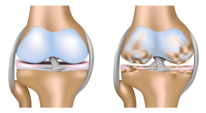 cartílago sano y daño a la articulación de la rodilla con artrosis