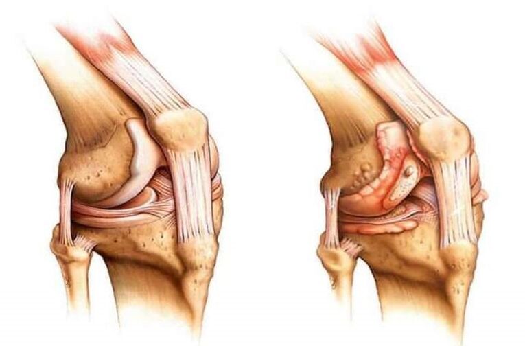rodilla sana y artrosis de la articulación de la rodilla