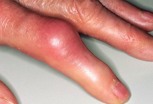 La gota se acompaña de dolor agudo en los dedos e hinchazón de las articulaciones. 