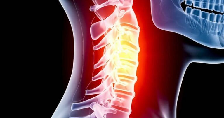 Inflamación de la región cervical
