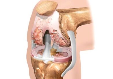 Daño a la articulación de la articulación de la rodilla