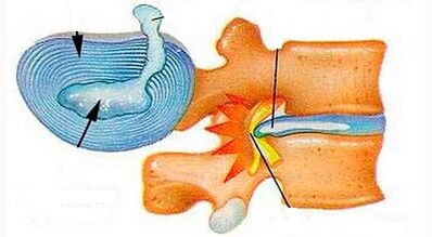 Características del desarrollo de la osteocondrosis cervical